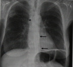 Снимки МРТ и КТ. Тромбоэмболия легочной артерии