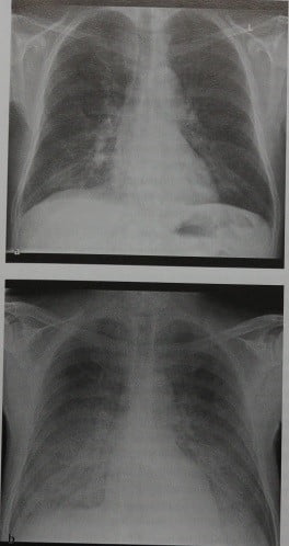 Снимки МРТ и КТ. Альвеолярный отек легких