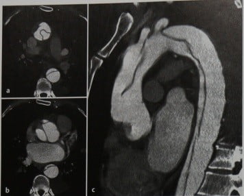 Снимки МРТ и КТ. Расслоение аорты - средостение