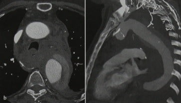 Снимки МРТ и КТ. Расслоение аорты - средостение