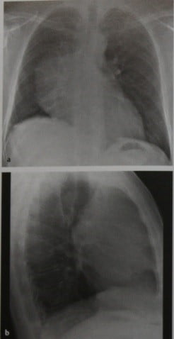 Снимки МРТ и КТ. Опухоли тимуса
