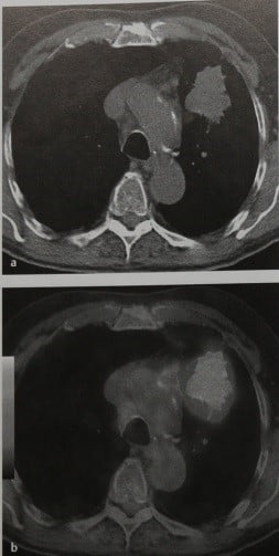 Снимки МРТ и КТ. Метастазы в лимфатические узлы
