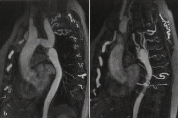 Снимки МРТ и КТ. Коарктация аорты - средостение