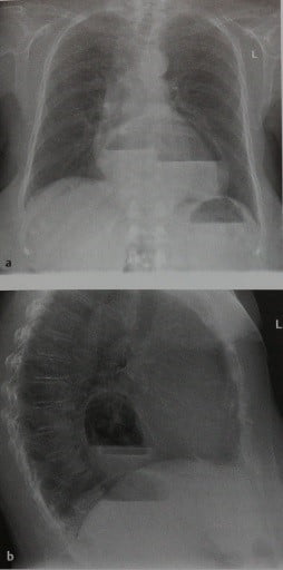 Снимки МРТ и КТ. Диафрагмальные грыжи и грыжа пищеводного отверстия