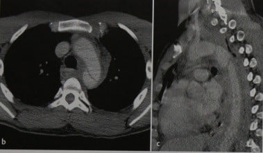 Снимки МРТ и КТ. Разрыв аорты