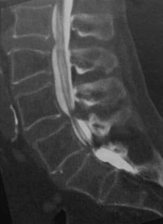 Снимки МРТ и КТ. Стеноз спинномозгового канала