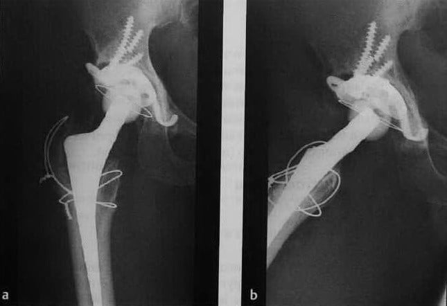 Снимки МРТ и КТ. Ослабление фиксации имплантата