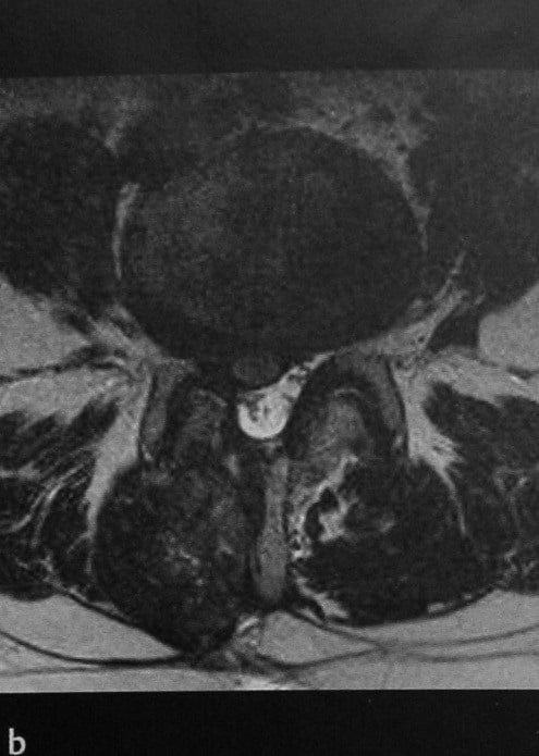 Снимки МРТ и КТ. Грыжа межпозвонкового диска