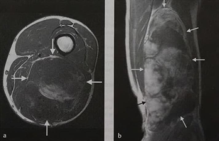 Снимки МРТ и КТ. Саркома мягких тканей