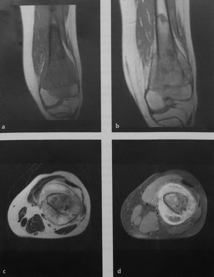 Снимки МРТ и КТ. Остеосаркома
