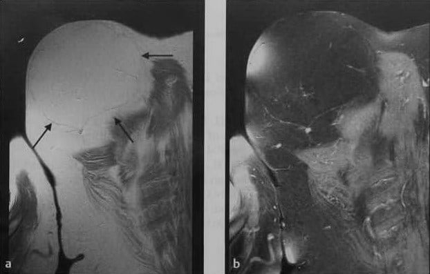 Снимки МРТ и КТ. Липома мягких тканей
