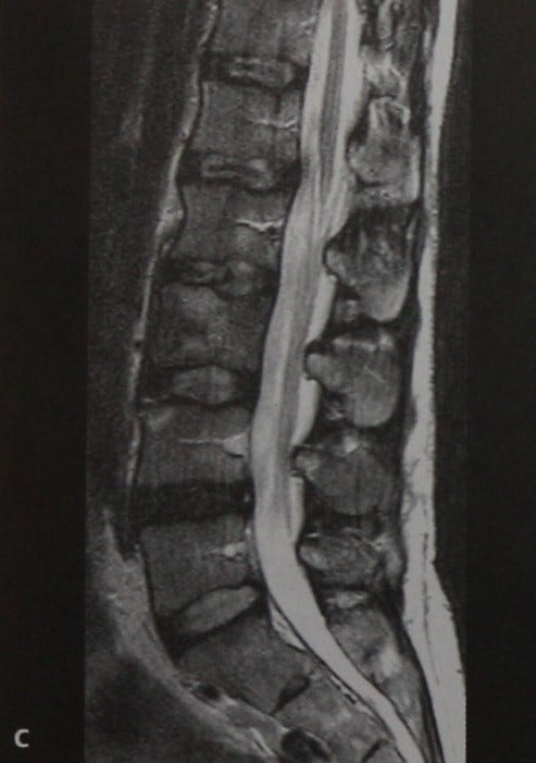 Снимки МРТ и КТ. Лимфома кости
