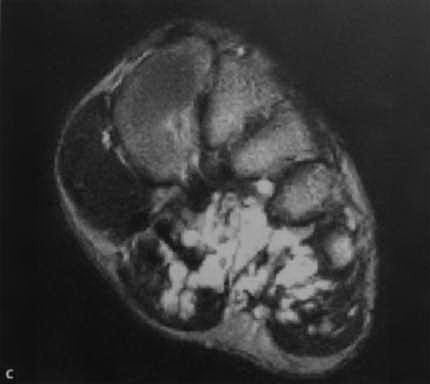 Снимки МРТ и КТ. Гемангиома мягких тканей