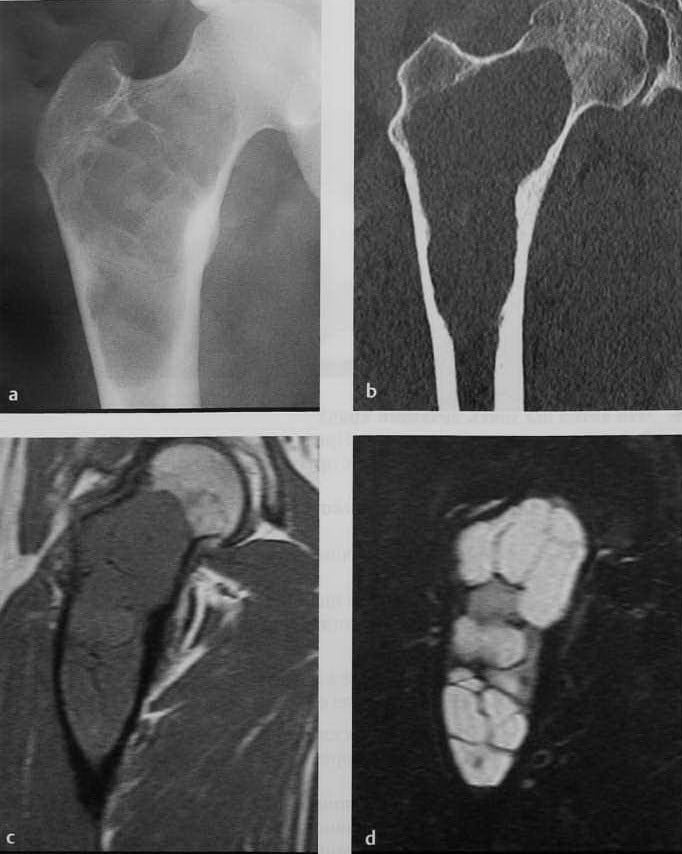 Снимки МРТ и КТ. Аневризматическая киста кости