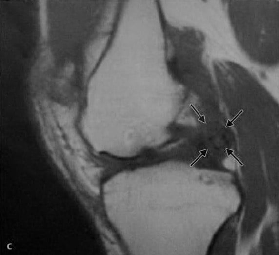 Снимки МРТ и КТ. Синовиальный хондроматоз