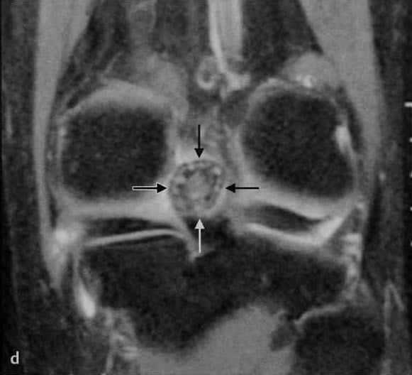 Снимки МРТ и КТ. Синовиальный хондроматоз