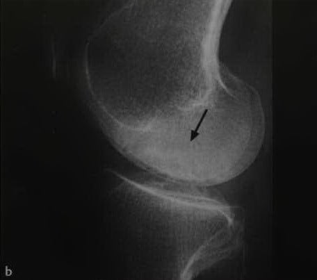 Снимки МРТ и КТ. Остеонекроз коленного сустава
