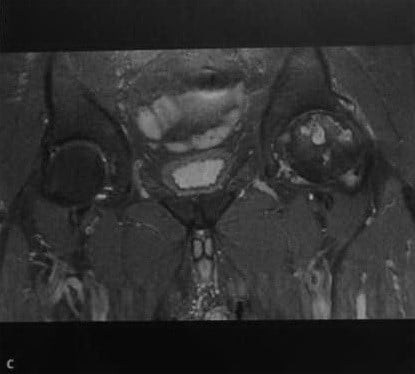 Снимки МРТ и КТ. Некроз головки бедренной кости