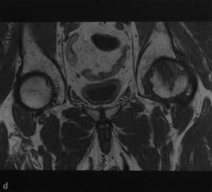 Снимки МРТ и КТ. Болезнь Пертеса