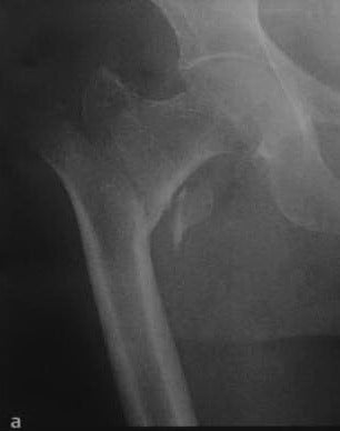 Снимки МРТ и КТ. Чрезвертельный перелом бедренной кости