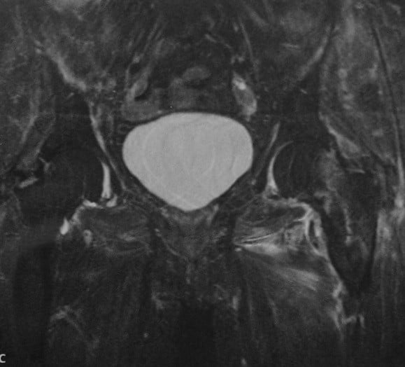 Снимки МРТ и КТ. Скрытые переломы