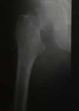 Снимки МРТ и КТ. Перелом шейки бедренной кости