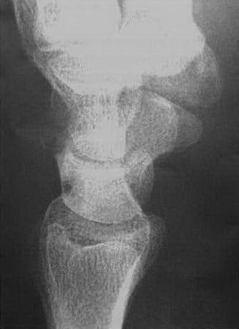 Снимки МРТ и КТ. Перелом трехгранной кости