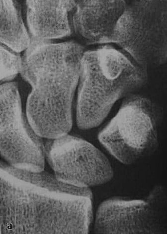 Снимки МРТ и КТ. Перелом трехгранной кости