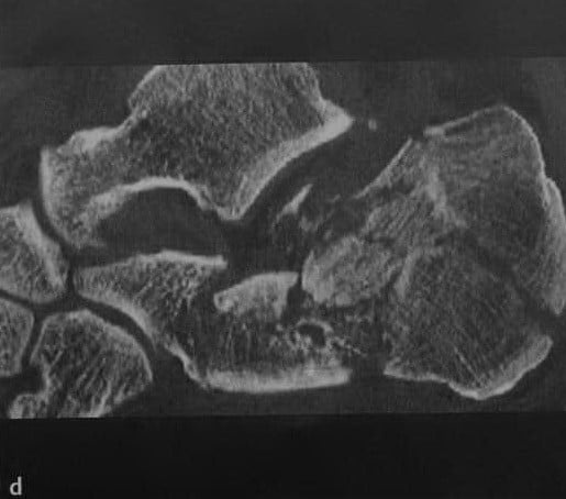 Снимки МРТ и КТ. Перелом пяточной кости