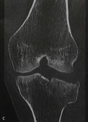 Снимки МРТ и КТ. Перелом плато большеберцовой кости