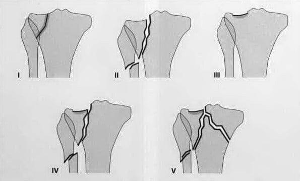 Снимки МРТ и КТ. Перелом плато большеберцовой кости
