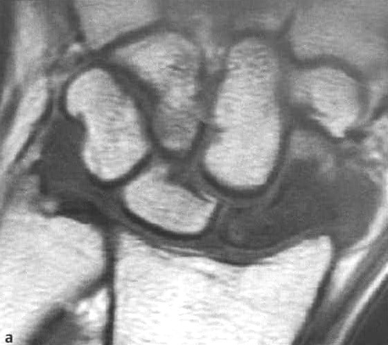 Снимки МРТ и КТ. Перелом ладьевидной кости