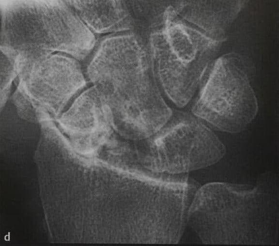 Снимки МРТ и КТ. Перелом ладьевидной кости
