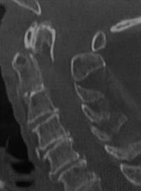 Снимки МРТ и КТ. Перелом зубовидного отростка позвоночника