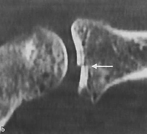 Снимки МРТ и КТ. Перелом головки лучевой кости