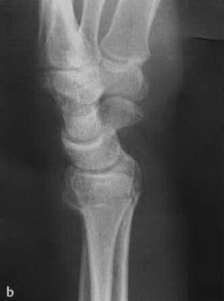 Снимки МРТ и КТ. Дистальный перелом лучевой кости