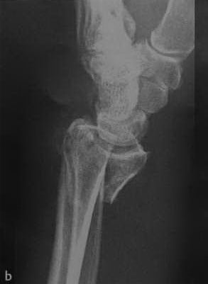 Снимки МРТ и КТ. Дистальный перелом лучевой кости