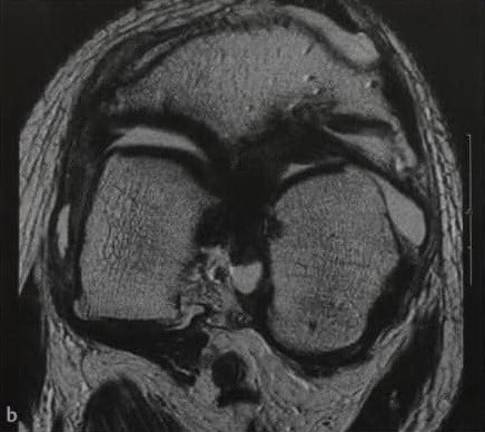 Снимки МРТ и КТ. Разрыв крестообразной связки