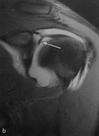 Снимки МРТ и КТ. Повреждения суставной губы плечевого сустава