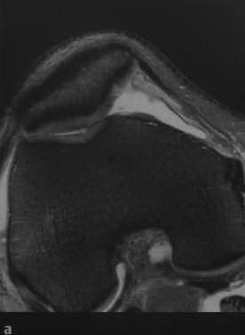 Снимки МРТ и КТ. Повреждения хряща коленного сустава