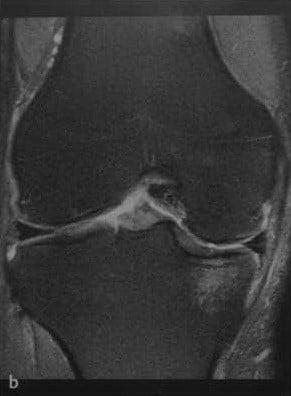 Снимки МРТ и КТ. Повреждения хряща коленного сустава