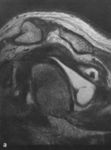 Снимки МРТ и КТ. Повреждения вращательной манжеты плеча