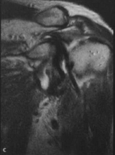 Снимки МРТ и КТ. Повреждения вращательной манжеты плеча