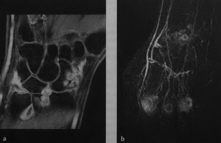 Снимки МРТ и КТ. Ревматоидный артрит - болезнь Стила