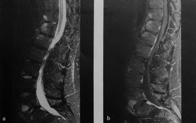 Снимки МРТ и КТ. Анкилозирующий спондилит - болезнь Бехтерева