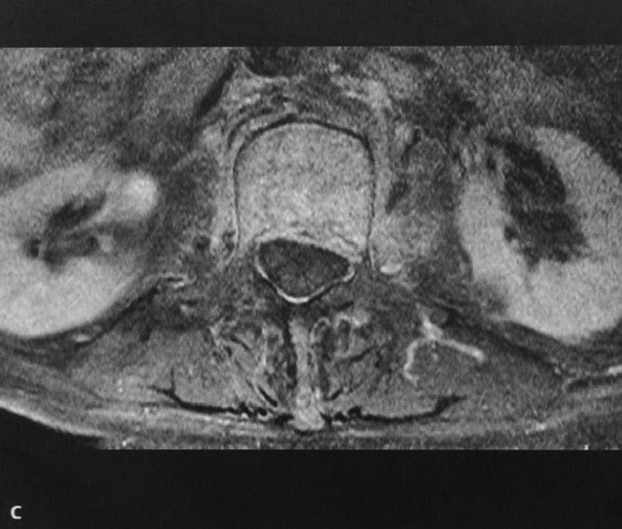 Снимки МРТ и КТ. Спондилит и спондилодисцит