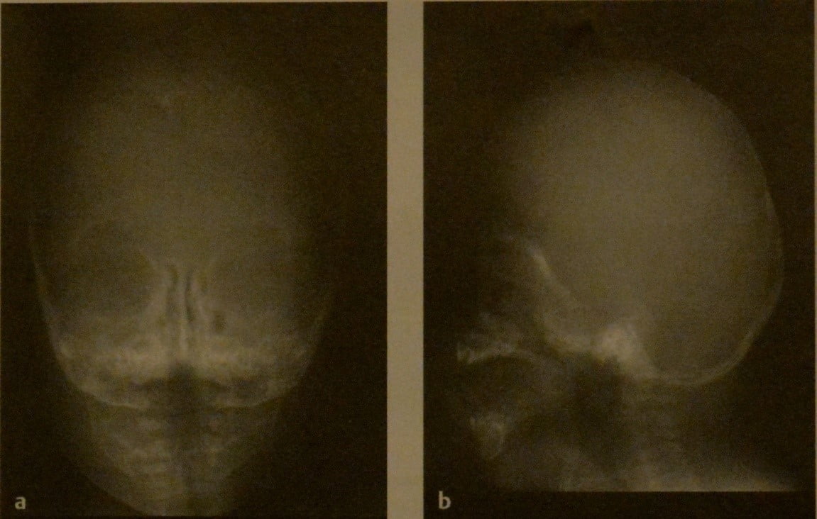 Снимки МРТ и КТ. Краниосиностоз у детей