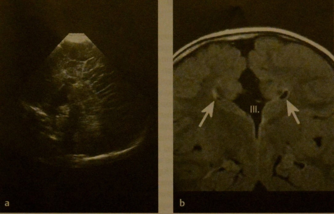 Снимки МРТ и КТ. Аномалии средней линии