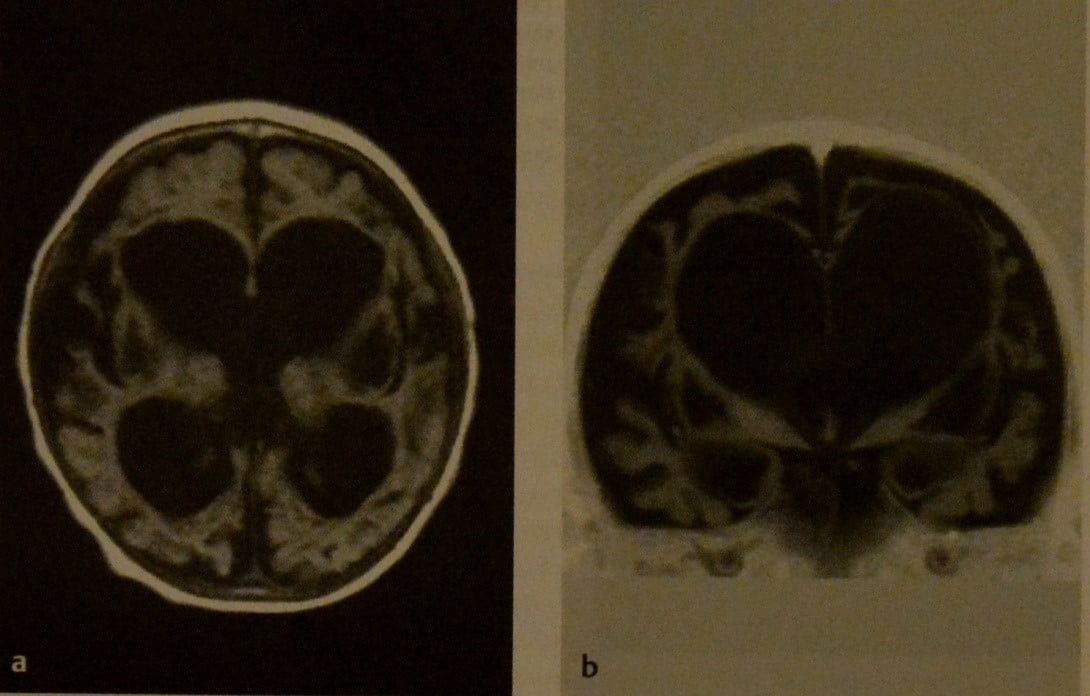 Снимки МРТ и КТ. Гипоксически-ишемическая энцефалопатия