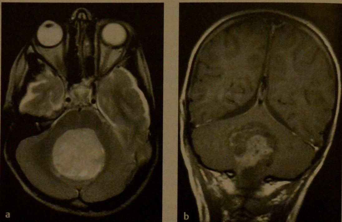Снимки МРТ и КТ. Опухоли задней черепной ямки у детей